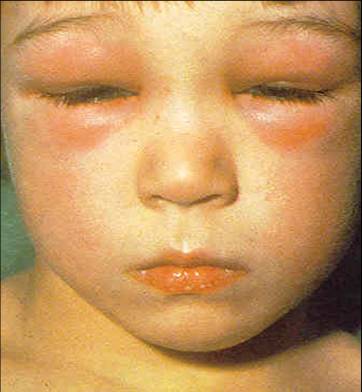 Inchados reação alérgica e urticária olhos
